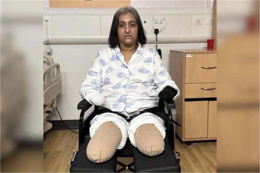 کتے کا چاٹنا پڑا مہنگا، جان لیوا ''سیپسس ''سے خاتون کے ہاتھ پیر کاٹنے پڑے، 6 بار دل کا دورہ پڑا